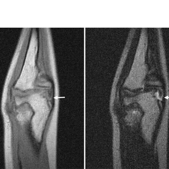 MRI Screening Both Elbow